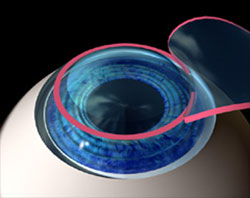 Treating nearsightedness, the cornea is made flatter