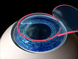Treating astigmatism, the cornea is made more spherical