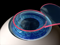 Treating farsightedness, the cornea is made steeper
