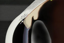 narrow-angle-glaucoma