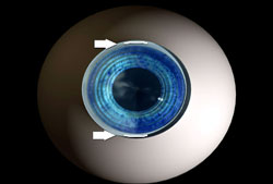 Your surgeon may elect to make micro-incisions in the cornea to reduce your astigmatism.
