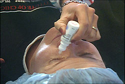 The area around your eyes will be cleaned and a sterile drape may be applied around your eye